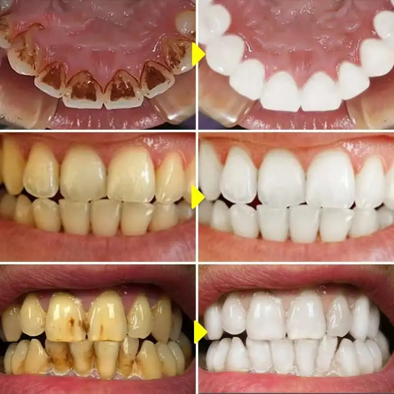 Smile Club Teeth Whitening Powder ✨