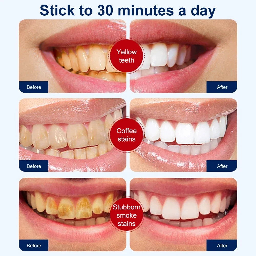 Smile Club 5D Teeth Whitening Strips ✨
