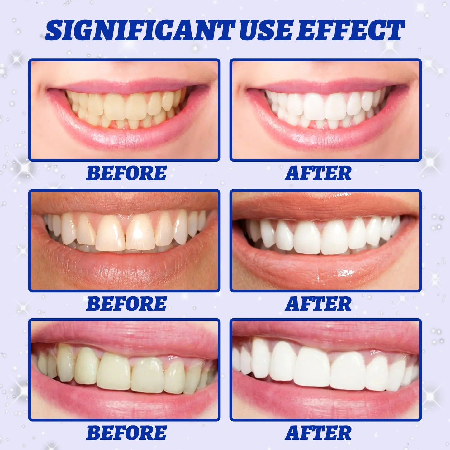 Smile Club 5D Teeth Whitening Strips ✨